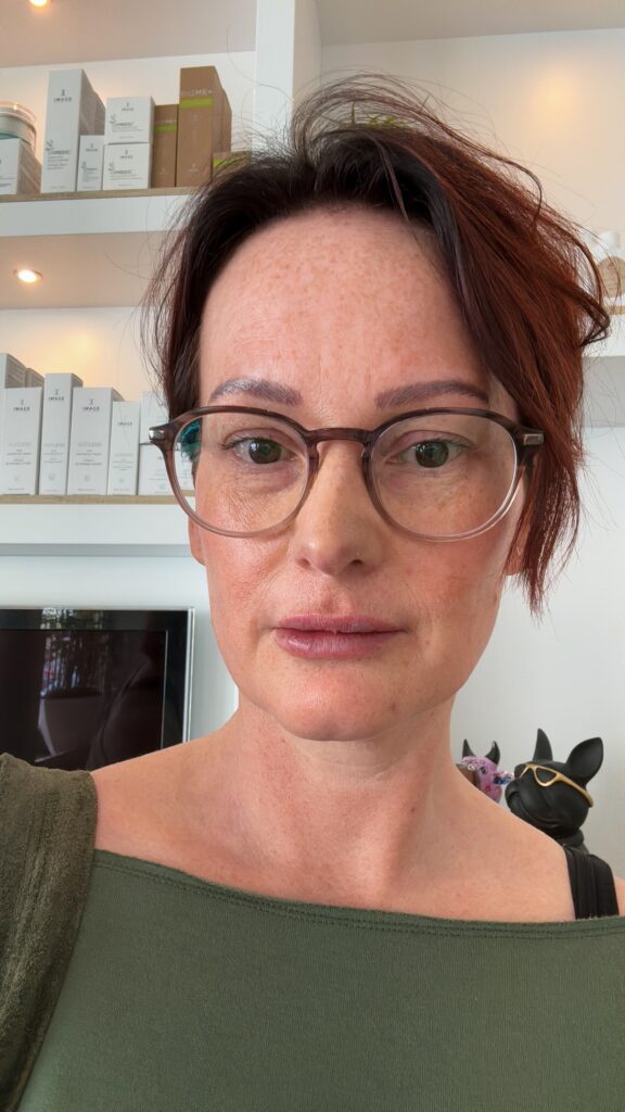Marie-Louise met lipfiller